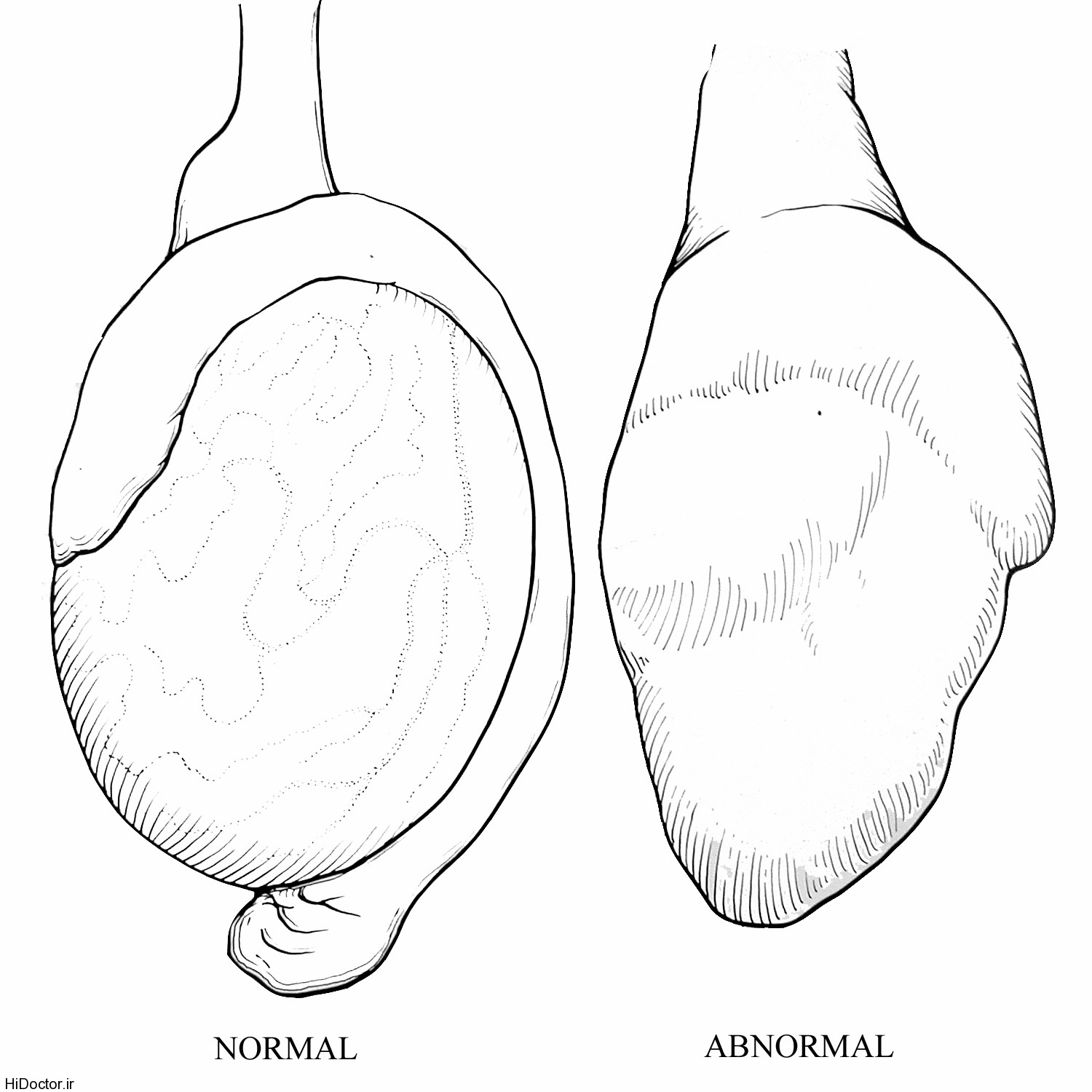 normal abnormal testicle