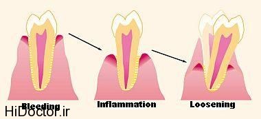 periodontitis course