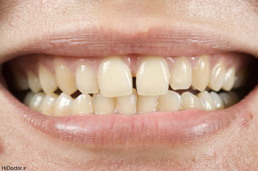 yellow-teeth-1