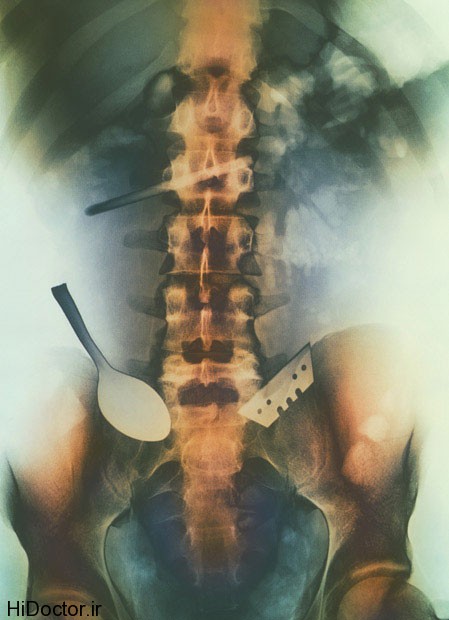 عجیب و غریب ترین عکس های رادیولوژی که تا بحال دیده اید 1