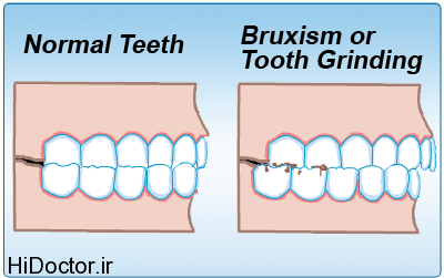 Bruxism