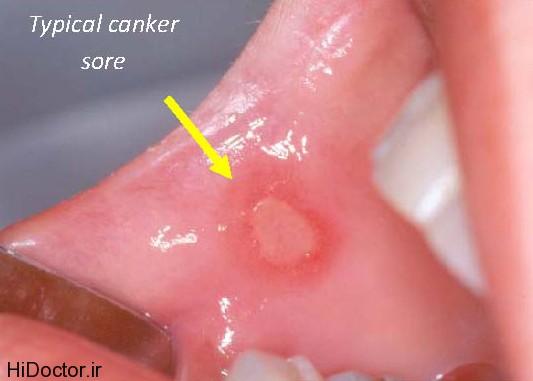 Typical-canker-sore