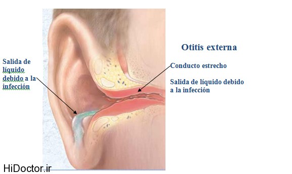 otitis-externa_4