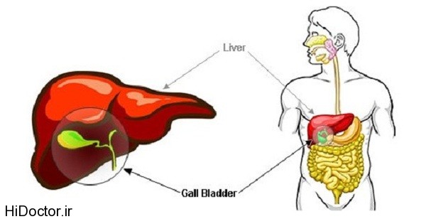 stone-gallbladder