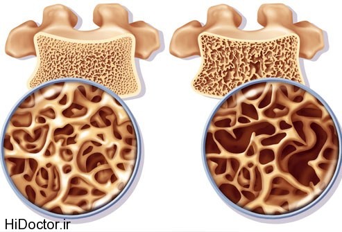 Osteoporosis