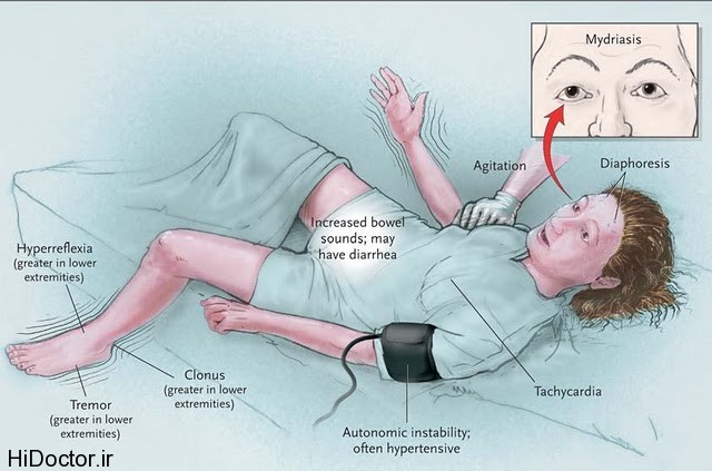 Serotonin-syndrome