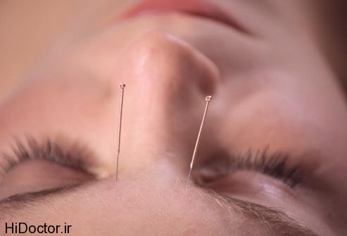 acupuncture