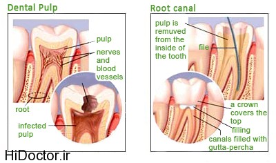 dental-pulp-root-canal