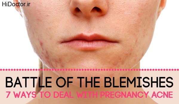 7-Ways-to-Deal-With-Pregnancy-Acne