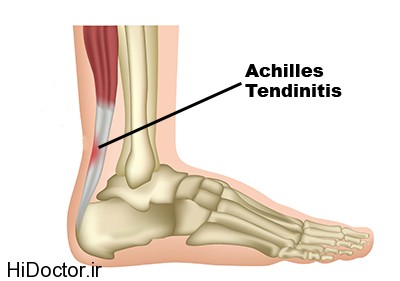 [تصویر:  achilles-tendonitis1.jpg]