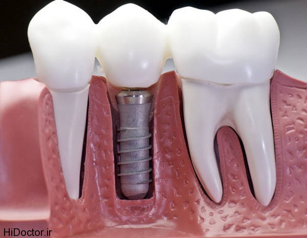 dental-implant (1)