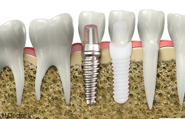 dental-implant (10)