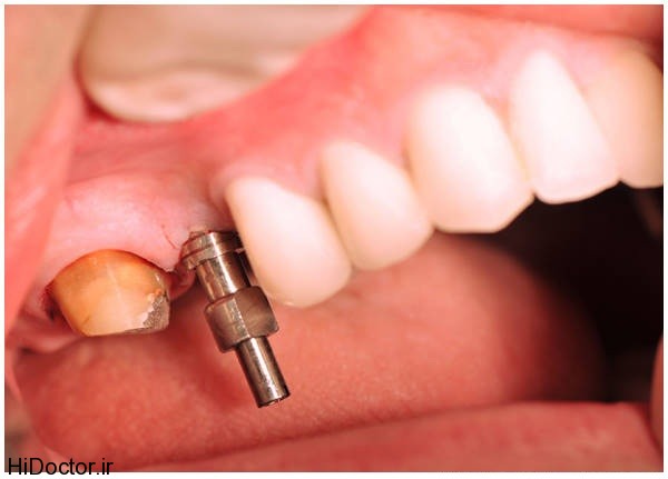 dental-implant (11)