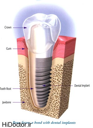 dental-implant (14)