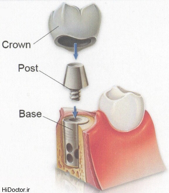 dental-implant (15)