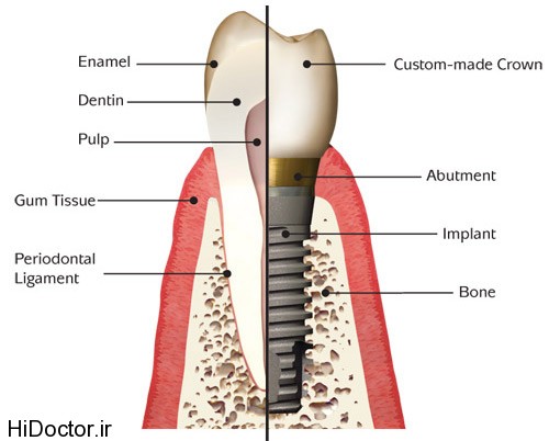 dental-implant (2)