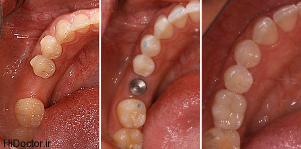 dental-implant (3)