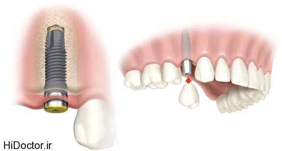 dental-implant (4)