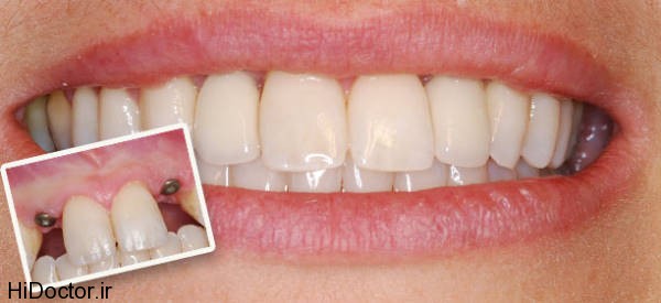 dental-implant (5)