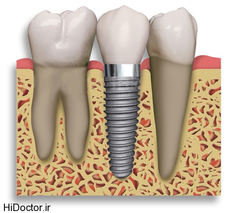 dental-implant (6)