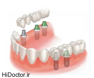 dental-implant (7)
