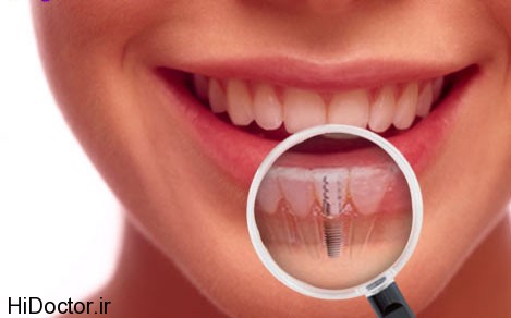 dental-implant (8)