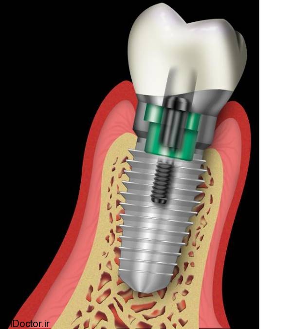 dental-implant (9)