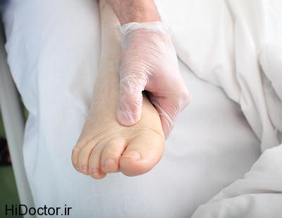 edema-swelling-