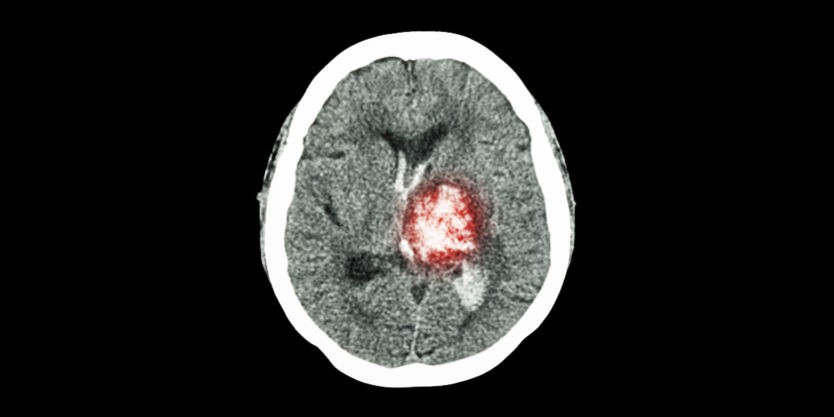 stroke-brain