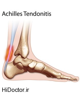 thm-achilles-tendonitis.jpg
