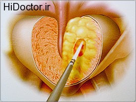 Urological surgery laser (10)