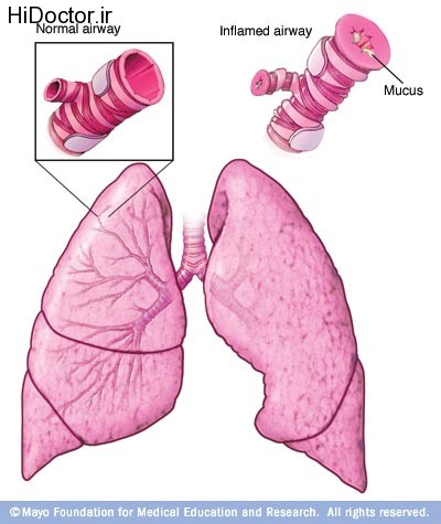 asthma11