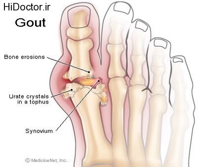 gout-symptoms-lyme-disease