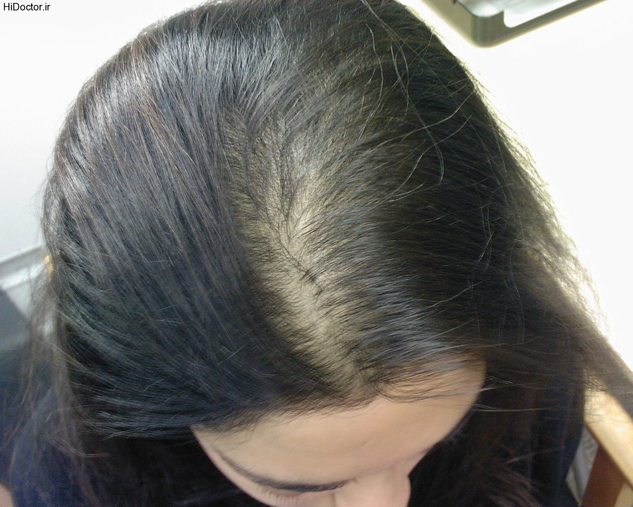 درمان ریزش غیر طبیعی مو