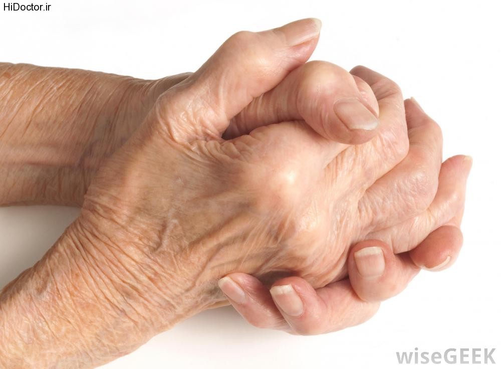 hands-of-arthritis