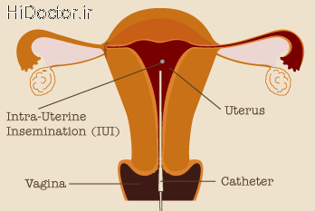 IUI-intrauterine-insemination_0