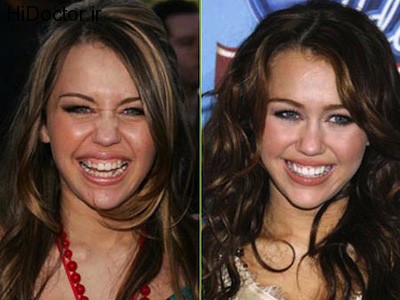 Miley-Cyrus-teeth-before-after-cosmetic-dentistry