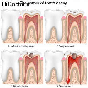 Preston-Dentist-Tooth-Decay-stages
