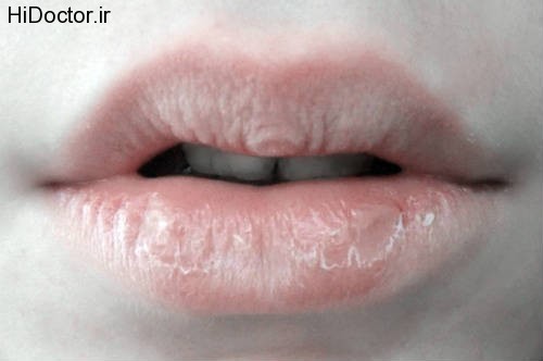 dry-lips