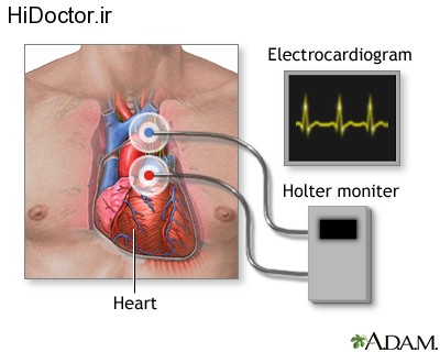 holter monitoring (13)