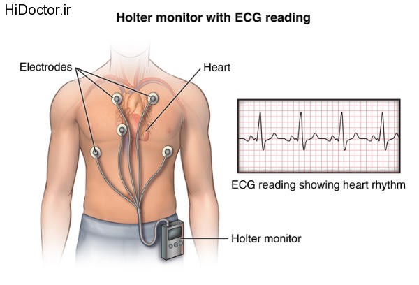 Front view male figure torso with holter monitor and ecg/heart rhythm inset