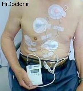 holter monitoring (6)
