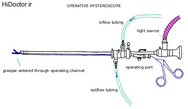 hysteroscope (13)
