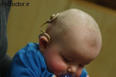 Infant_with_cochlear_implant