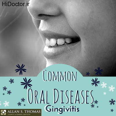 Oral-Diseases-Gingivitis