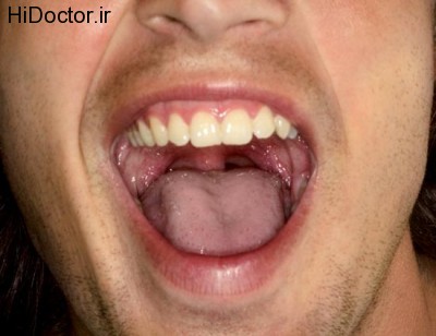 علائم بیماری در بزاق دهان . 1