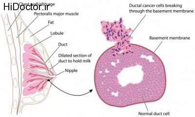 ductal-carcinoma
