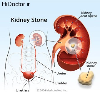 kidney-stones-s2-illustration