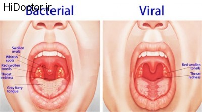 tonsillitis-viral-bacterial