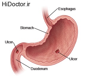 Anterior view of coronal section of the stomach Original Exit Writer image is 116114 added peptic ulcer